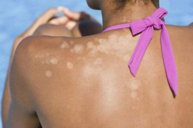 Što učiniti ako se na koži pojave mrlje nakon sunčanja?