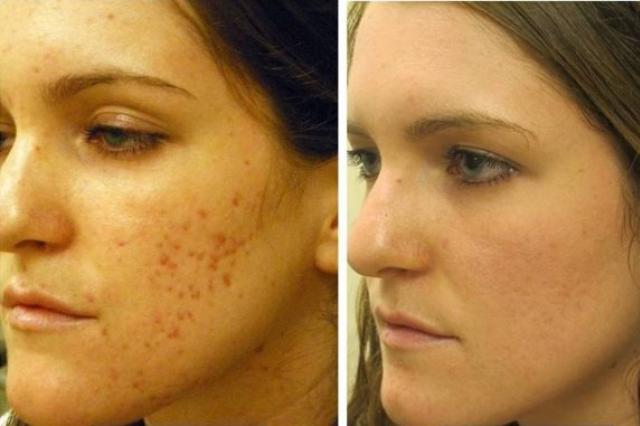 Što je mezoterapija lica, kako djeluje i koji se uspjeh može postići: fotografije prije i poslije injekcija ljepote