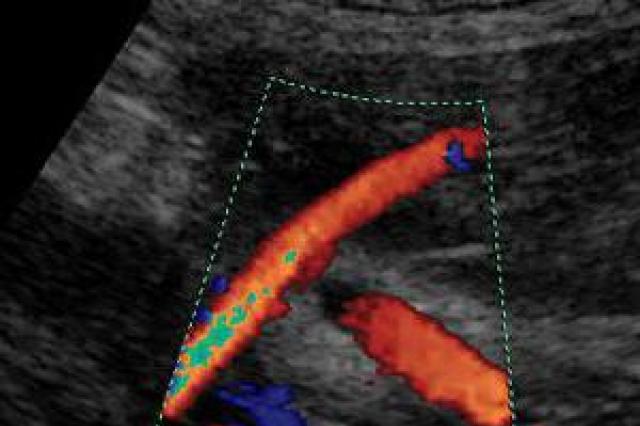 Doppler ultrazvuk tijekom trudnoće: kako i kada se radi dopler, njegovo dekodiranje i norme Koliko tjedana radi dopler